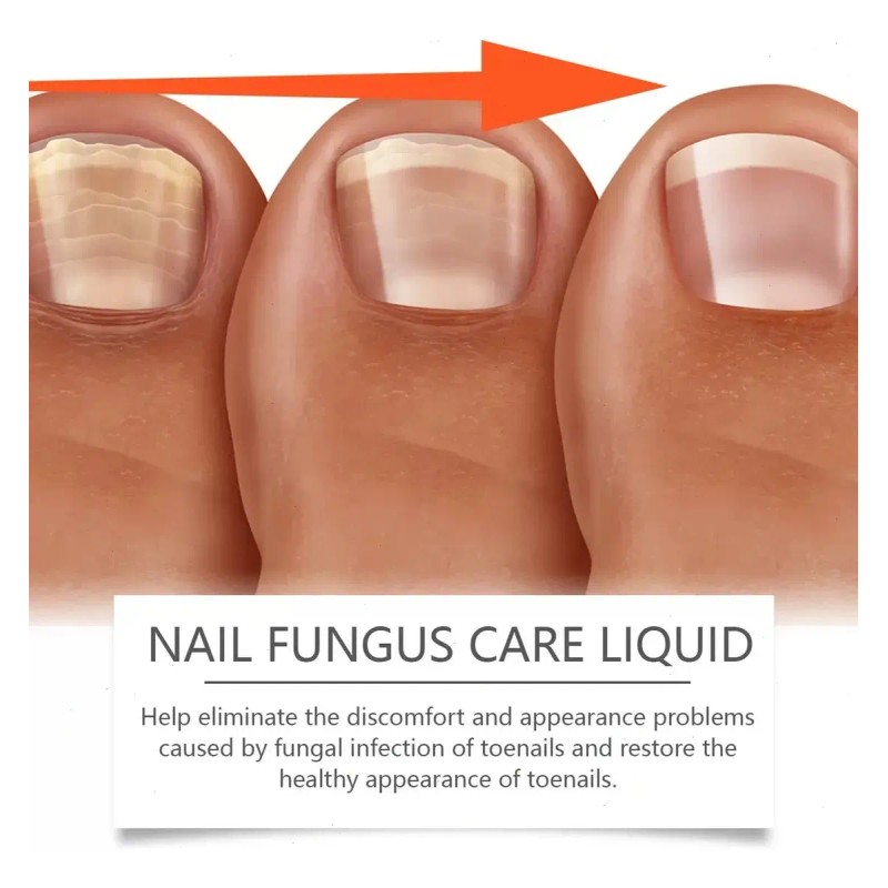 Líquido Para Hongos En Uñas - Cura Hongos Y Onicomicosis