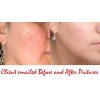 100% Pure Treat Rosacea Seriously With Your Personal Rosacea Treatment