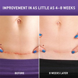 Care Science C Section Recovery Silicone Scar Sheets 1.5in x 7in 8ct | Reuseable Scar Sheets for Reducing the Appearance of C-Section, Keloid, and Acne Scars