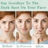 Quitamanchas para rostro y cuerpo, corrector de manchas oscuras con