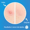 Parches para Acne,Pimple Patch, Parches para Espinillas, Almohadillas Hidrocoloides para