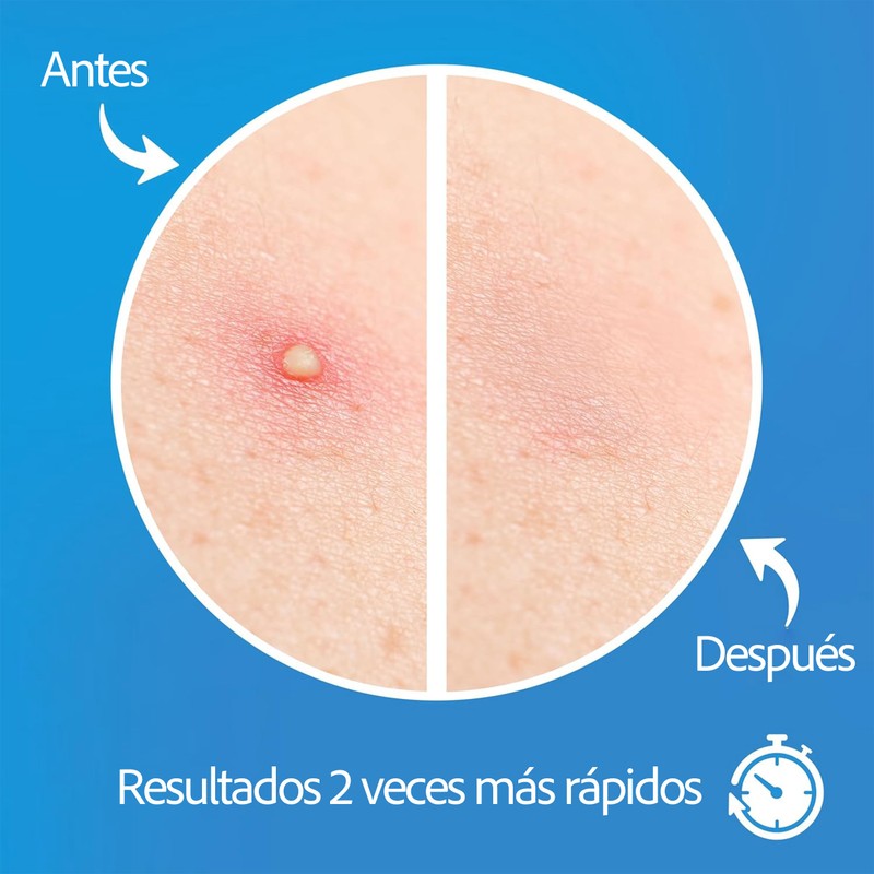Parches para Acne,Pimple Patch, Parches para Espinillas, Almohadillas Hidrocoloides para