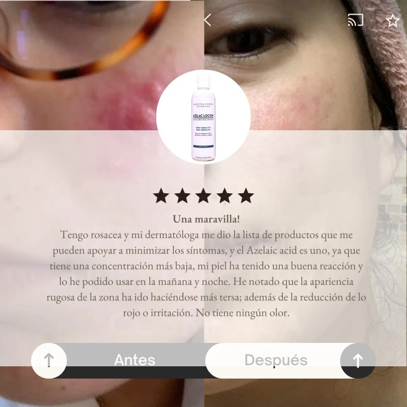 Controla El Acne Matifica Desinflama Rosacea Locion Azelaico Momento de
