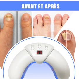 Nail Fungus Laser Against Nail Fungus Device for Multiple Fingernails and Toenails, Nail Fungus Laser for Damaged and Discoloured Nails with Digital Displays and Timing Function (White)