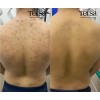Crema Tersa Despigmentante Quita Manchas Acné Paño De 40g