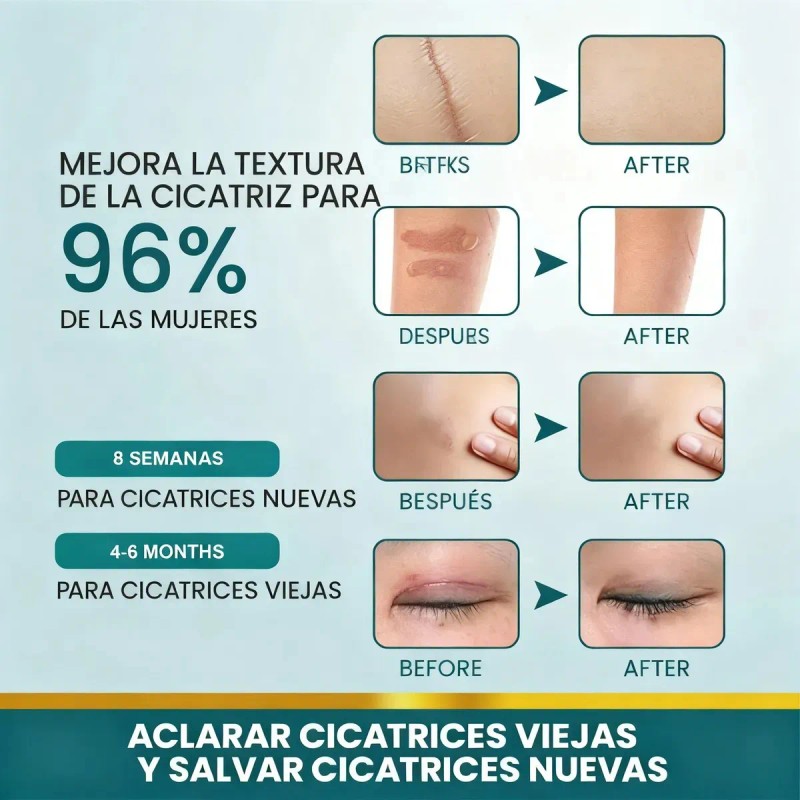 2 cajas Parche de silicona para cicatrices, adecuado para cicatrices