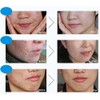 Bioaqua Acne Cream Cicatrices Poros Control De Grasa 1 Pzs