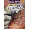 Tattoo Removal