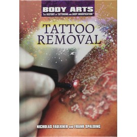 Tattoo Removal