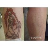 Tattoo Removal Removal Dark Spot Mole Removal Dark Pen Mole
