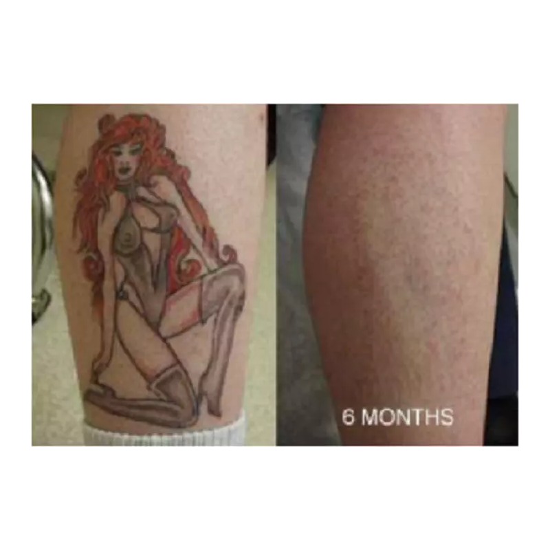 Tattoo Removal Removal Dark Spot Mole Removal Dark Pen Mole