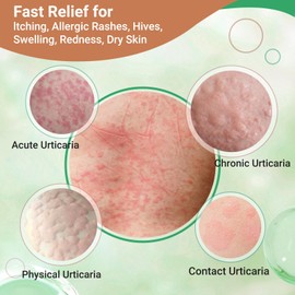 LMNOOP Urticaria Cream for Hives Relief - Fast Acting Anti Itch Treatment with All Natural Herbal Formula for Skin Allergic Rashes, Redness, Swelling 3.53 oz