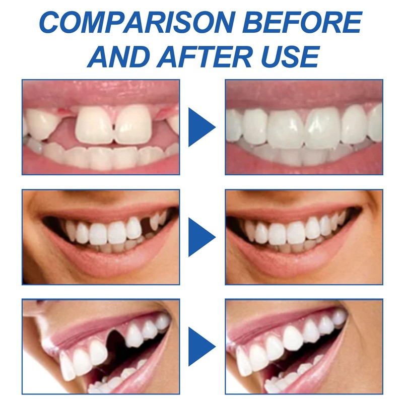 Temporary Tooth Repair Kit, Moldable Filling for Temporary Tooth Repair