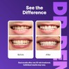 DR.DENT Purple Teeth Whitening Strips 7 Treatments - Enamel Safe