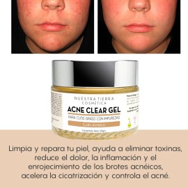 Gel Facial Anti-acné Envío Directo Tipo de piel Graso con Impurezas