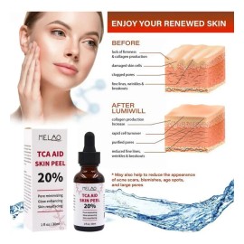 . 30 Ml De Tca Aid Exfoliante Para La Piel, cido Tricloroac