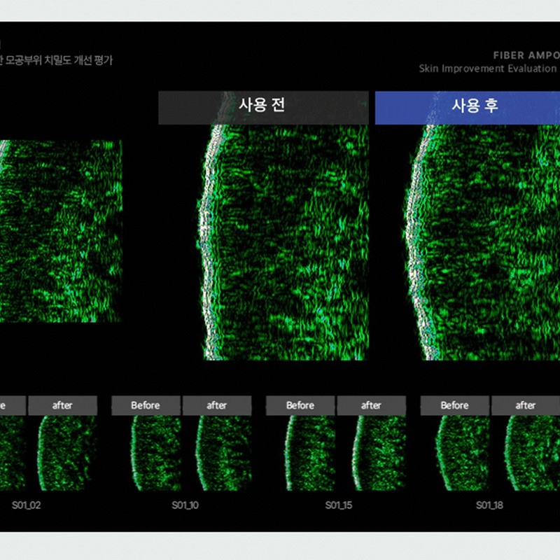 비에논 파이버 앰플 눈밑 꺼짐 처짐 눈밑지방 제거 pdrn 레티놀