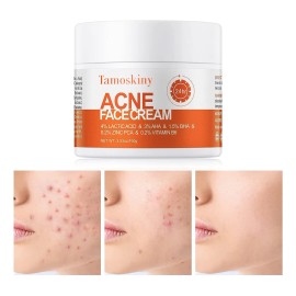 Crema Facial De Acné, Tratamiento Con Acné Quístico De Ácido