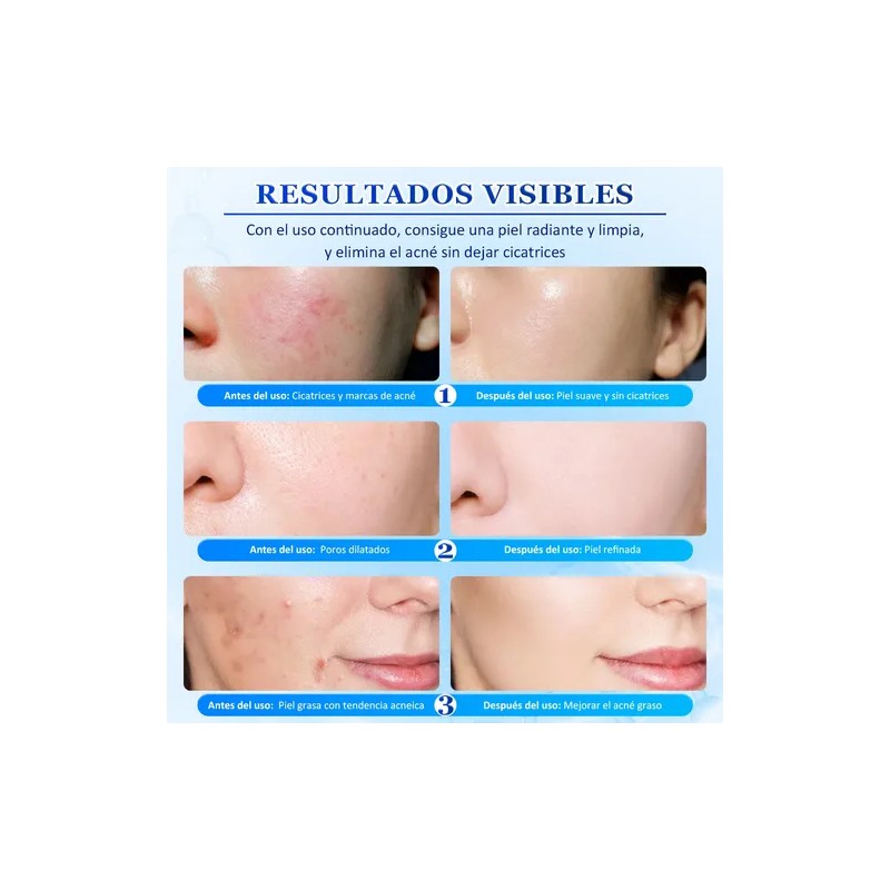Acne Buster Loción Secante Con Ácido Salicílico 10ml