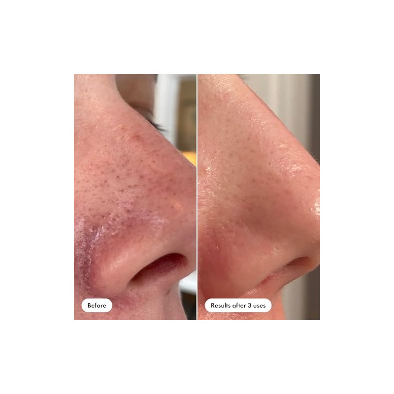 HERO COSMETICS Solución Exfoliante Para Puntos Negros Pore Release, Tónico