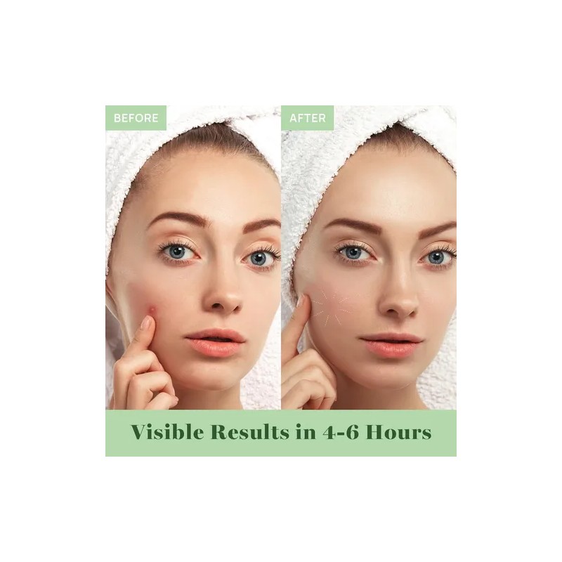 Cover Healing Invisible Acne Patch Blemish Spot, Treatment,