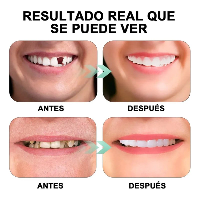 Dientes Postizos Temporal Falsos Carillas Dentales