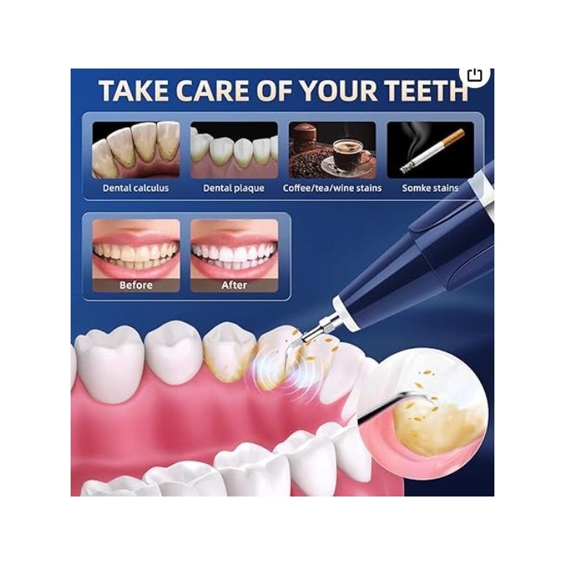 Plaque Remover for Teeth - Tartar Remover for Teeth, Dental
