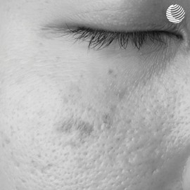 Dr. Rimpler Aufhellendes Gesichts-Serum für pigmentgestörter Haut "Brightening" I Gesichtspflege zur Minderung von Pigementflecken I für einen porzelanfarbenen Teint, 20ml