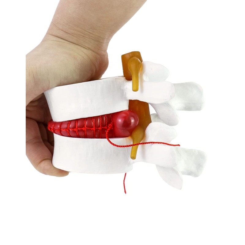 QWORK Anatomical Human Lumbar Vertebrae Degenerative Spine Model - for