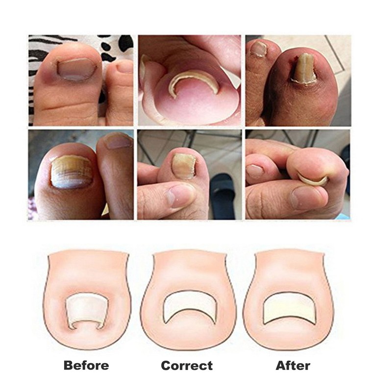 Ingrown Toenail Lifter Set Toenail Patch Sleeves Tweezers Stainless Steel