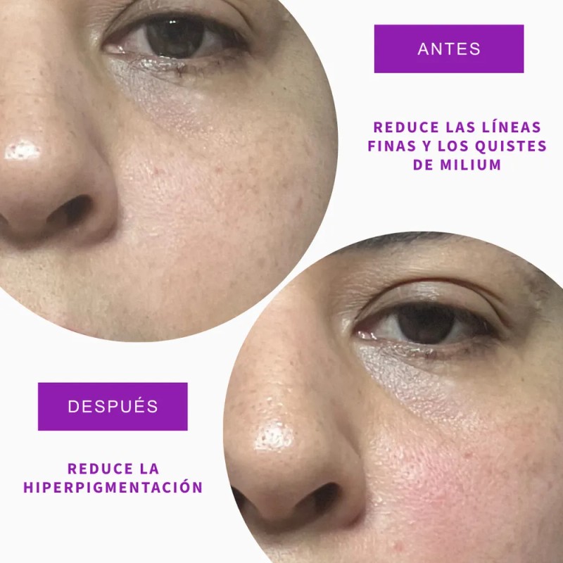 Ohm Pharma Sistema Microinfusión Anti Edad