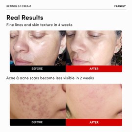 FRANKLY Retinol 0.3% Cream, 0.7 fl oz - Intensive Retinol | Night Cream | Ceramides & Natural Ginseng | Anti-aging, Wrinkles Care, Reduces Congestion and hyperpigmentation | Korean Skin Care