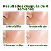 Liquido Antiacne Serum Reparador Espinillas Acido Salicilico