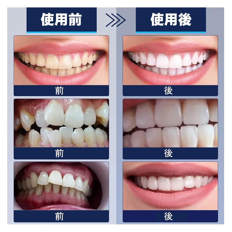 dentures dentures dentures false teeth fake teeth peony dentures instant