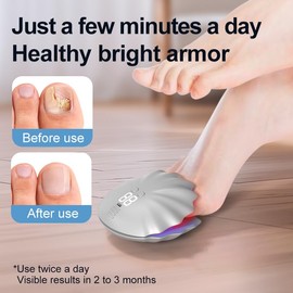 5.0 Qualität Nagelpilz Laser & Zeitmessgerät & Fruchtig Nail Care Pen【Stärkste Therapie-Schnell Wirkende】Nagelpilz Lasergerät【SGS Zugelassen-Sicher und Zuverlässig】Verbesserte