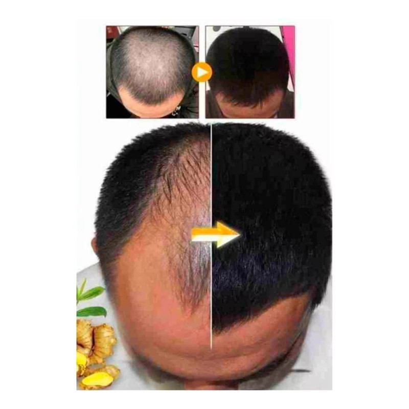 Racotex Locion Para Crecimiento De Pelo Y Barba 100% Efectivo