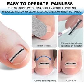 Upgraded ingrown toenail treatment, nail kit, Ingrown Toenail Treatment, Ingrown Toenail Removal Kit, Designed for Curved Nail Repair, Ingrown Toenail Corrector, Suitable for many types of correction.