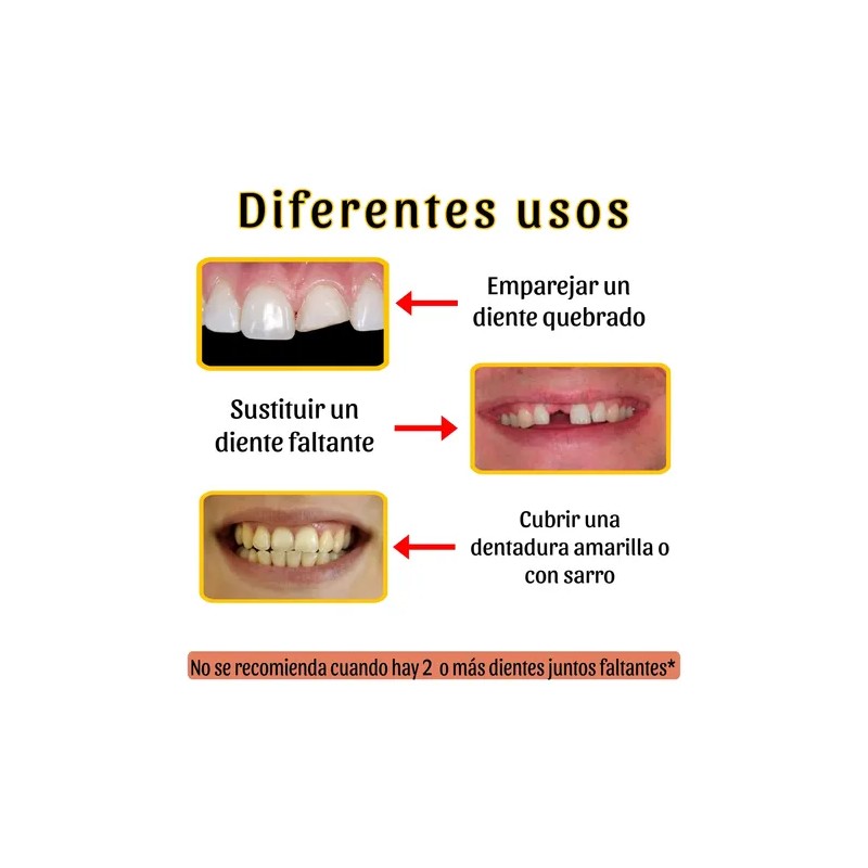 Carillas Estéticas Snap On Smile Veneers Dientes Temporales