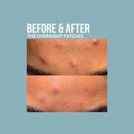 Absorbzit - The Overnight - 36 Night Time Patches - 12 x Large, 24 x Small - Cruelty Free - Vegan