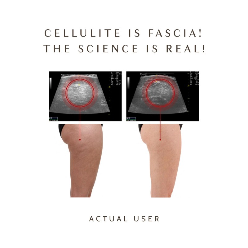 Ashley Black’s FasciaBlaster Trigger Point Fascia Tools for Recovery, Anti-Cellulite