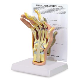 GPI Anatomicals - Human Anatomy Model of Right Hand with Rheumatoid Arthritis, Replica for Anatomy and Physiology Education, Anatomy Model for Doctor's Office and Classrooms, Medical Study Supplies
