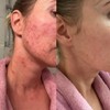 Dermz Acne Treatment - Acne Cream, SPF Face Protection, Face