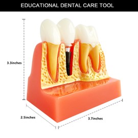 Dental Implant Model with Removable Crown Bridge - 4 Times Enlarged Demonstrative Teeth Model for Education and Study - Ideal for Class Demonstrations and Dental Student Training