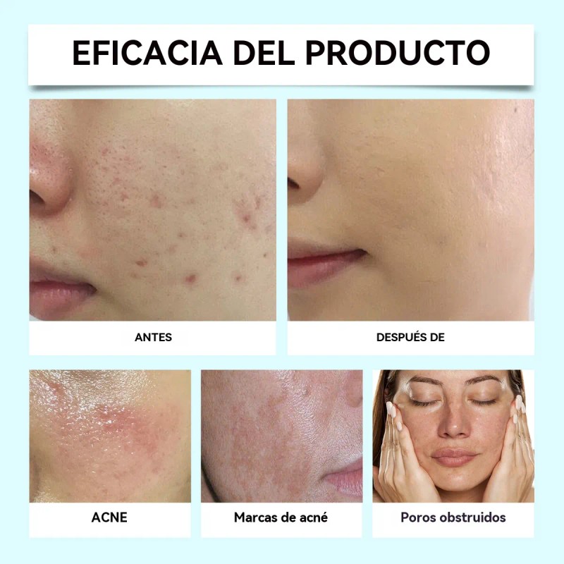 Crema Ácido Azelaico Crema Para El Acné Con Ácid 20g