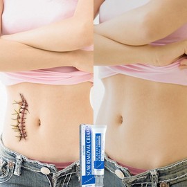 Professional Scar Removal Gel- Scarremoval treatment for keloids, C-sectionS, surgeries, burns, acne andmore. - Specification: 2pcs