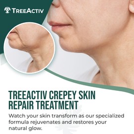 TreeActiv Crepey Skin Repair Treatment Original Formula, 8 fl oz, Firming Cream For Face & Neck, Skin Firming Lotion with Hyaluronic Acid, Crepey Treatment to Address Dry Crepe