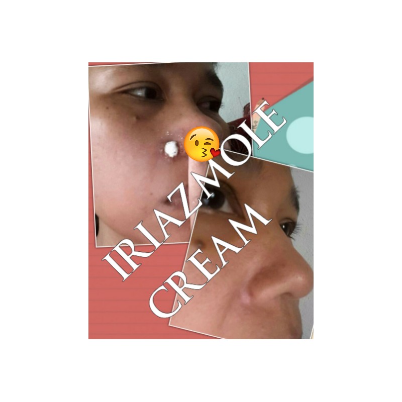 IRIAZ MOLE CREAM BUANG TAHI LALAT KUTIL BIJI KOLESTEROL