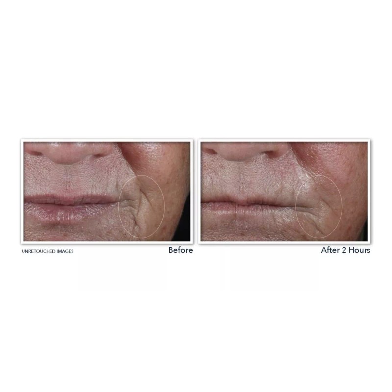 Roc Retinol Correxion- Parches Dirigido No Invasivos Arrugas