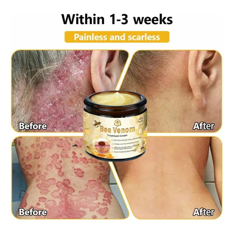 Bh Crema De Tratamiento For Piel De Abeja, Reduce