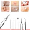 Whitehead Blemish Removal Tool Pimple Popper Tool Kit 8 Pcs